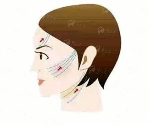 五、广东韩妃整形外科医院梁晓姻医生的特色项目及价格