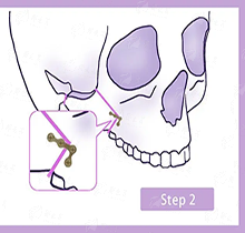 三、广东韩妃整形外科医院陈秋怡医生真实实例分享