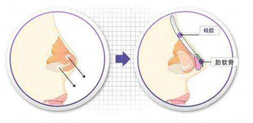 六、选择广东韩妃刘广元医生的优势