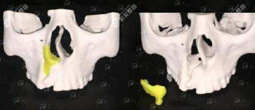 四、昆明唇腭裂修复医院怎么预约？国有私立选择建议