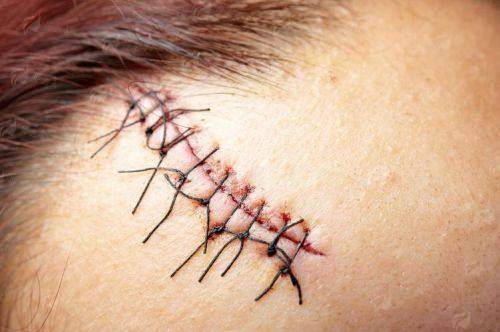 四、贵州医 科 大学附属医院的疤痕修复适合哪些人？