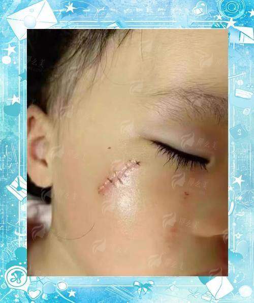 二、贵阳利美康外科医院的疤痕修复成效如何？