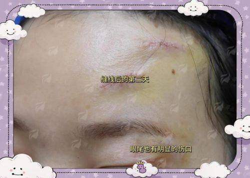 一、贵阳华医疤痕科的疤痕修复技术怎么样？