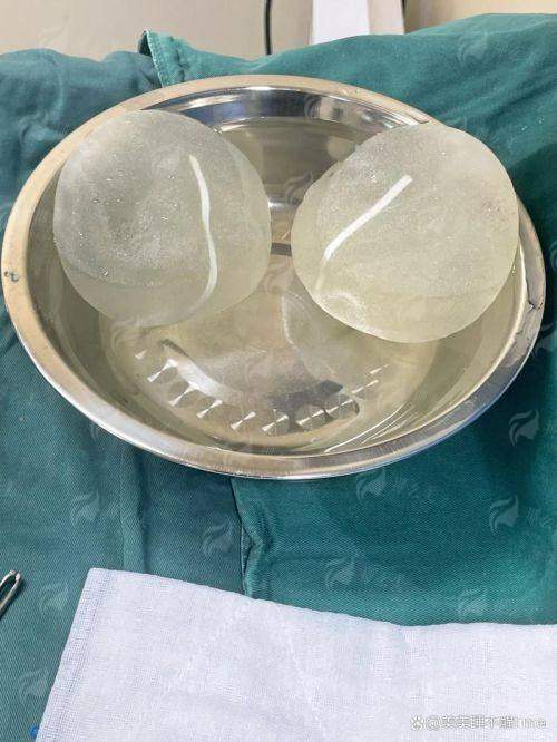 四、广东韩妃整形外科医院假体隆胸真实实例分享