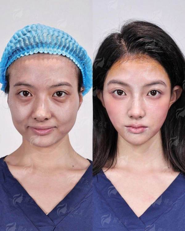 广东韩妃李宗磊双眼皮真实评价如何？案例全解析，附医院坐诊地址及24小时预约通道！