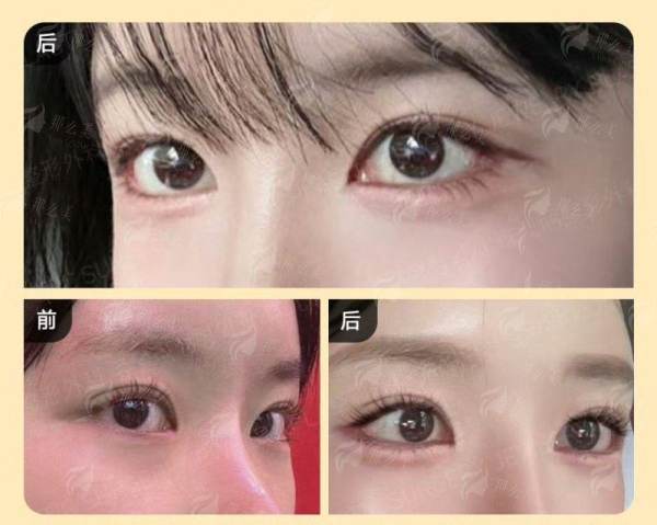 二、广东韩妃整形外科医院纪春华医生经典项目展示