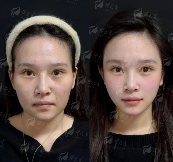 广东韩妃杨熙雯拉皮技术亮点全解析，适应人群、价格参考、附坐诊地址和预约挂号途径