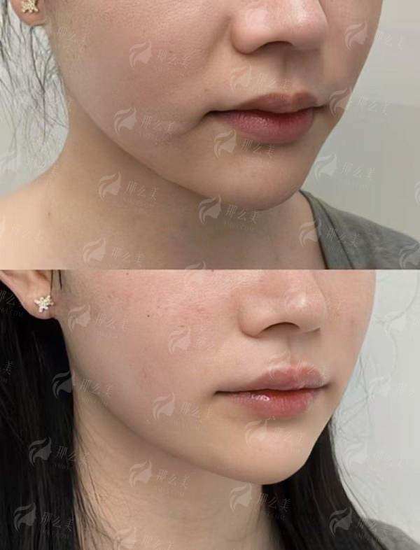 四、广东韩妃整形外科医院陈秋怡医生手术特点