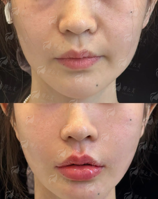 四、广东韩妃整形外科医院隆胸手术优势