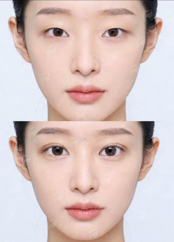 一、昆明韩辰双眼皮修复技术怎么样？