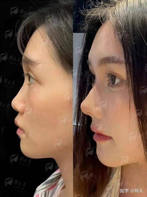 保定蓝山杜建龙院长隆鼻技术怎么样？真实案例+价格全解析