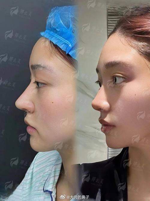 三、河北保定蓝山医疗美容医院隆鼻价格贵吗？