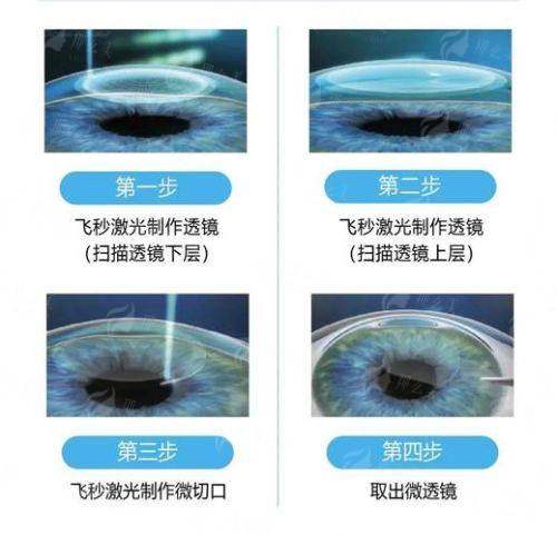 重庆南坪爱尔眼科医院半飞秒手术全过程实录