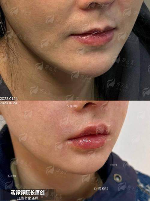 昆明铂玥医疗口周冻龄术全解析！30+女性必看的抗衰秘籍