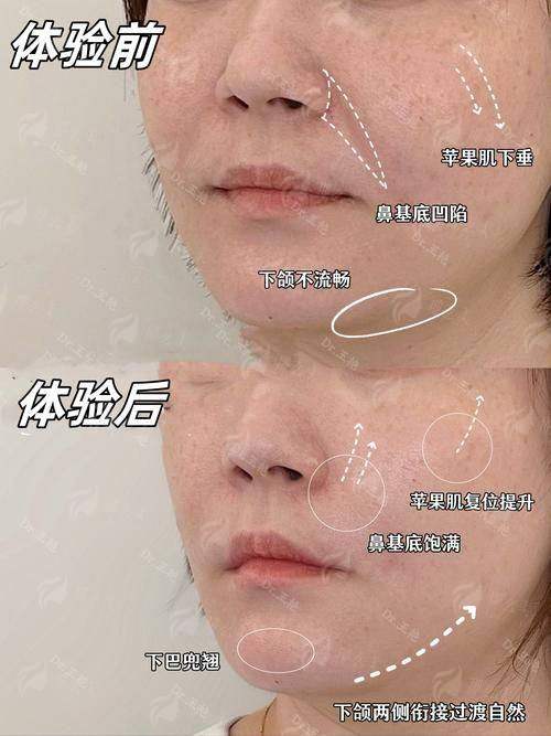 三、昆明铂玥医疗口周冻龄术适合哪些人？