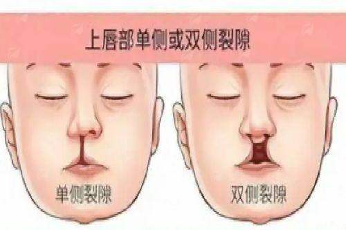 三、日照壹美天成唇裂修复价格贵不贵?