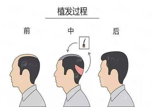 四、如何预约福州海峡美容医院的植发服务？