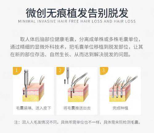 三、福州海峡美容医院植发价格是多少？