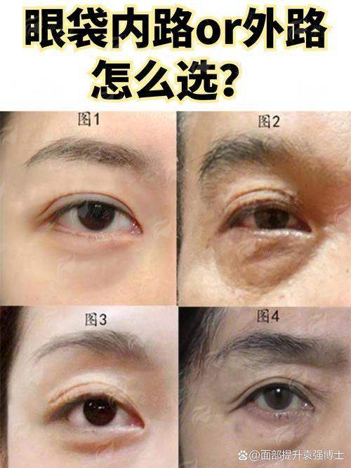 三、连云港鑫爱度医疗美容的无痕内吸眼袋价格及对比