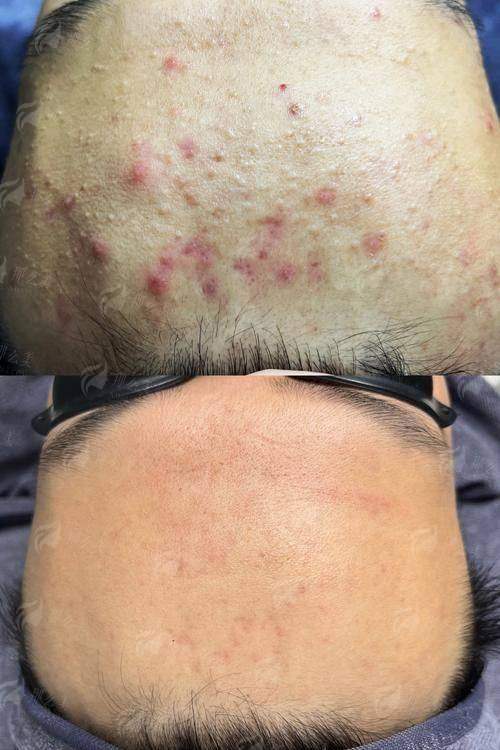 二、淮安艺后医疗整形医院的痘坑痘印修复技术好吗?