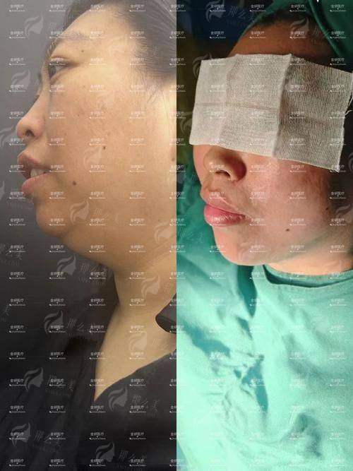 一、哈尔滨芮妮医美双下巴吸脂成效怎么样？