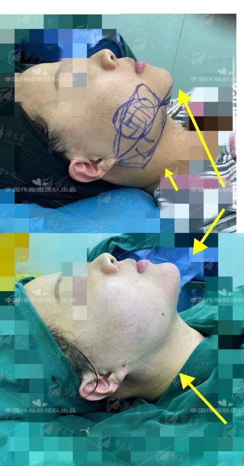 【云南昆明华美整形】夏磊医生面部吸脂真实案例全公开！吸脂效果对比看，预约方式速戳