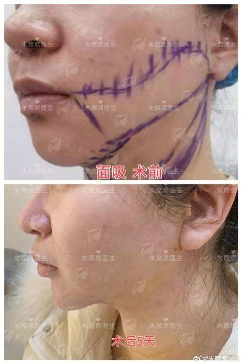 四、如何预约夏磊医生面部吸脂？
