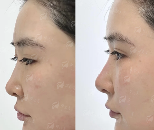 三、假体隆眉弓价格与常州市场对比