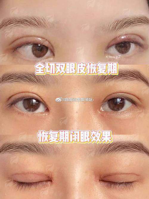 一、青岛诺德马昕眼修复技术怎么样？