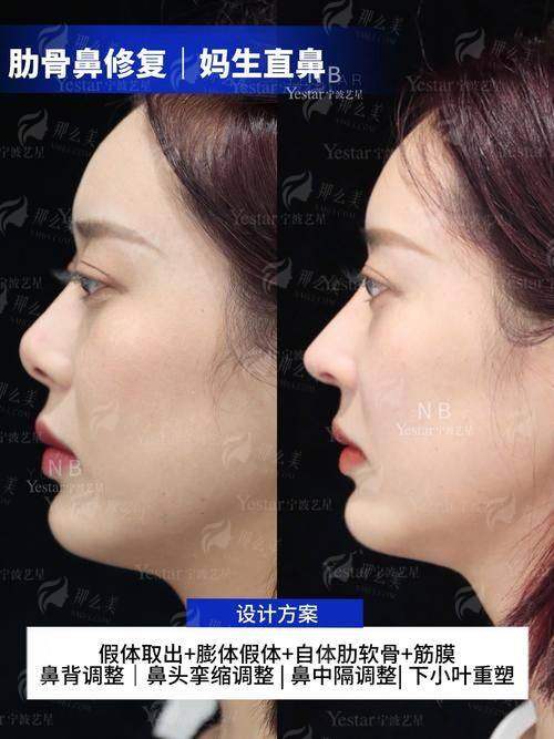 二、长沙星雅罗盛军做鼻综合真人实例实拍