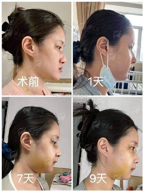 一、广州高尚黄金龙隆鼻的技术背景是什么？