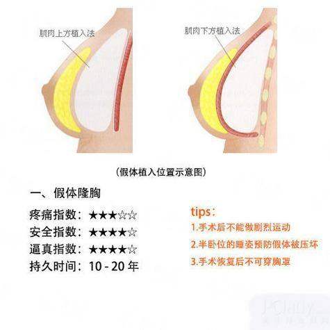 一、深圳富华唐新辉隆胸技术怎么样?