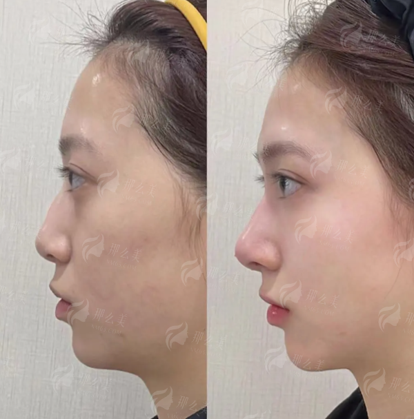 三、广州高尚黄金龙隆鼻的真人实例成效如何？