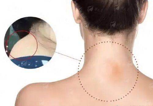 一、苏州铂蔓医疗富贵包整形价格公开！