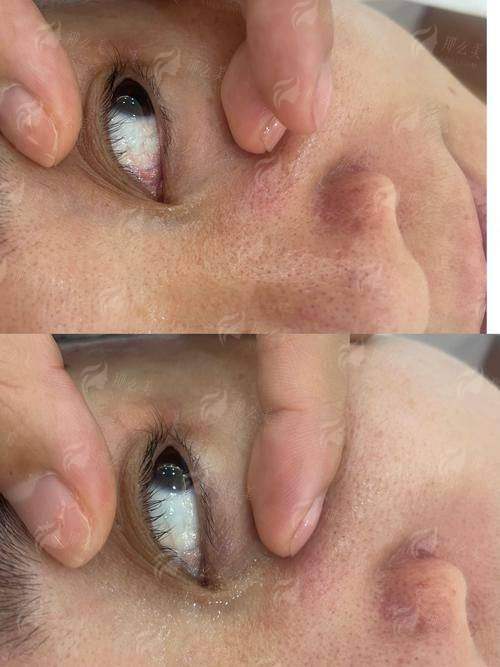 三、青岛诺德马昕眼修复价格贵吗？