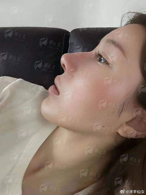 一、池鸿阳肋骨隆鼻技术为什么受兰州美亲追捧?