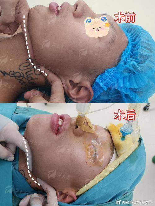 三、重庆星荣颌面整形价格对比，贵不贵？