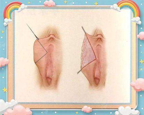 一、佛山美莱紧缩针为什么不推荐打?这些风险要警惕