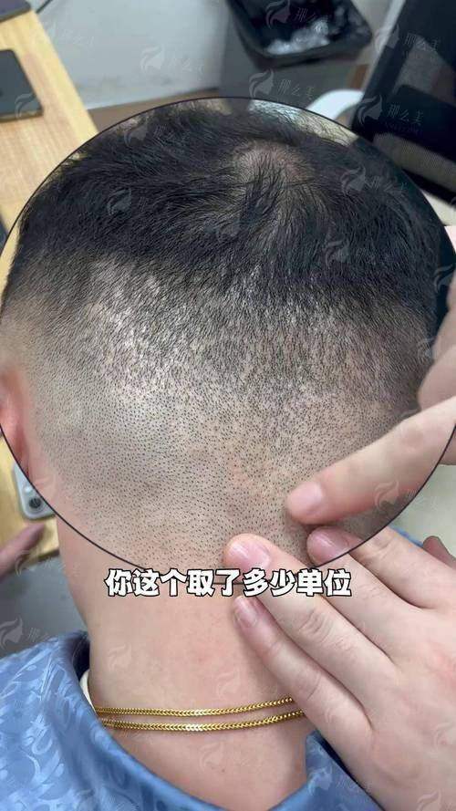 温州青禾植发郑方成院长毛发种植多少钱？2026最新价格表+术后效果全公开！
