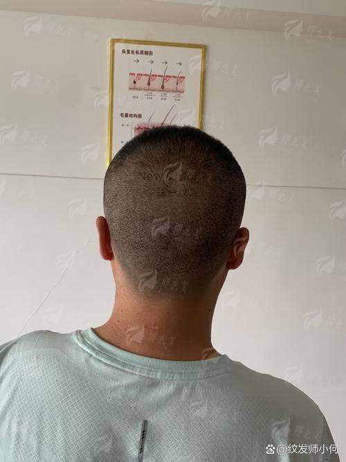 四、温州青禾植发怎么预约郑方成院长？