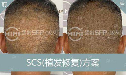 二、温州青禾植发毛发种植2024年价格贵吗？