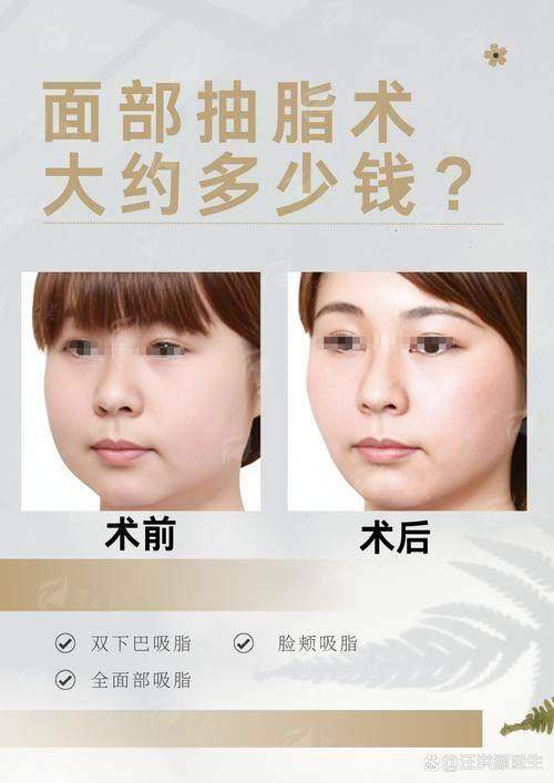 二、郑州缔莱美面部吸脂价格贵吗？