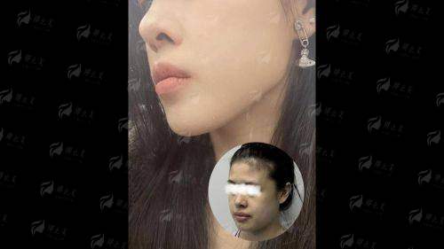 一、郑州缔莱美面部吸脂怎么样？