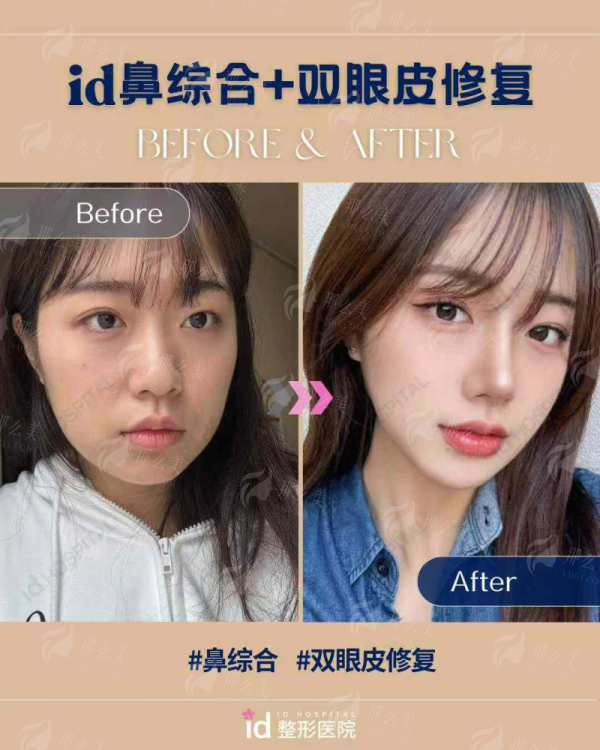 青岛诺德马昕做眼修复靠谱吗？术前术后对比+预约方式速看！