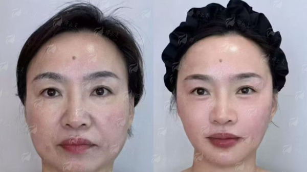 【重庆星荣颌面整形】刘正茂医生技术怎么样？真实案例全解析，价格对比看这里！