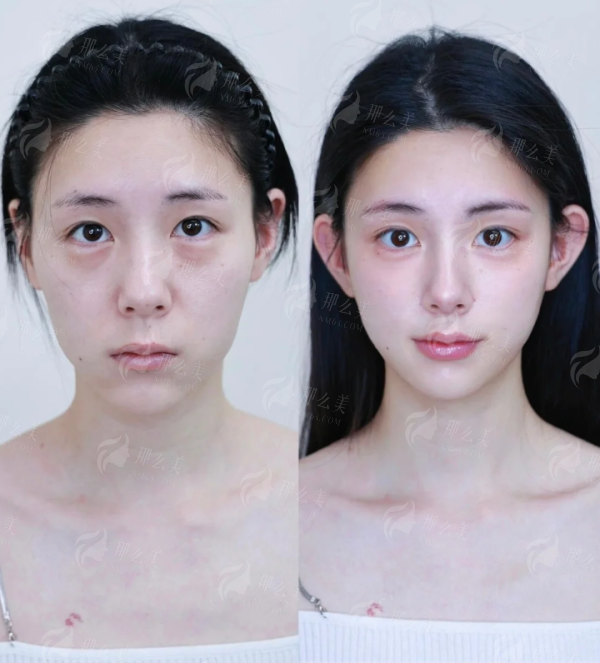 三、长沙华韩华美邓颖双眼皮修复期要多久？