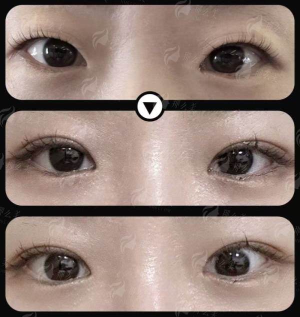临汾美特尔整形张兆博割双眼皮多少钱？价格分析+预约方式全公开！