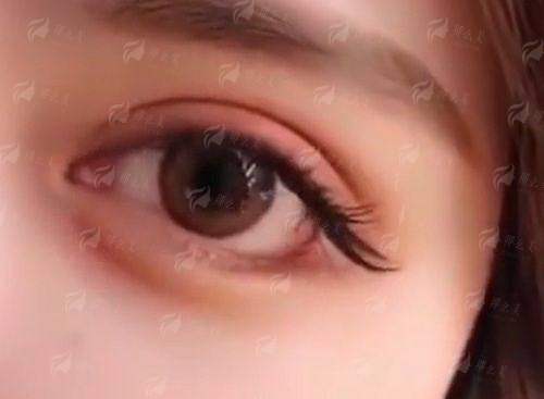 四、广东韩妃整形外科医院祛眼袋真实实例分享