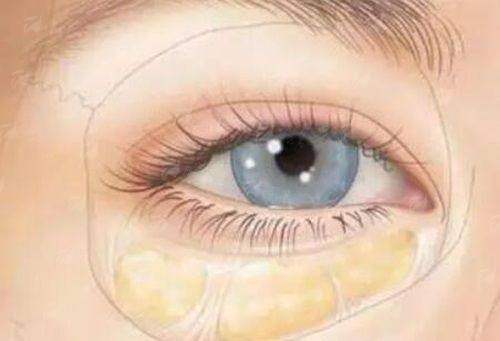 四、江苏省医院整形外科祛眼袋值得选吗?