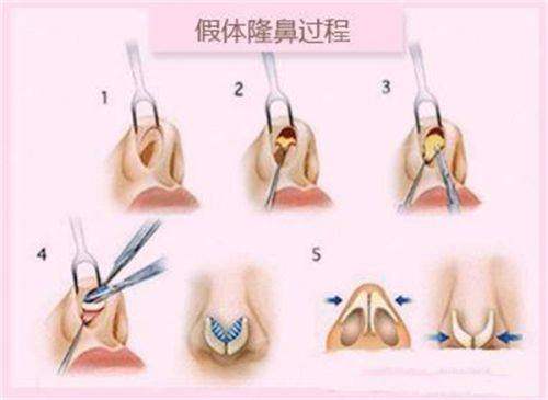二、隆胸手术方式及价格参考